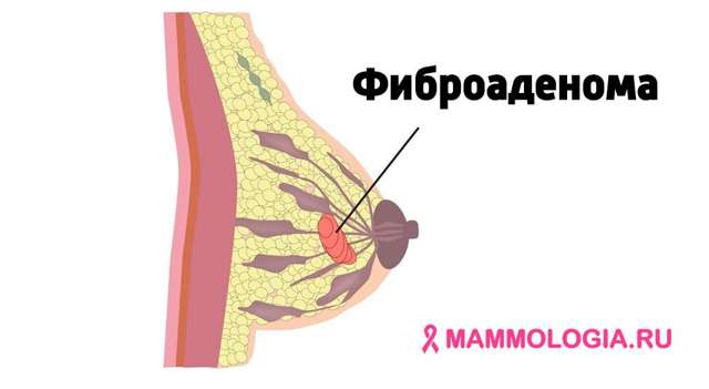 Фиброаденома молочной железы