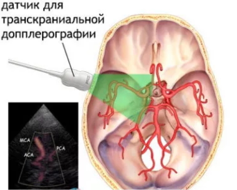 Дуплексное сканирование сосудов головного мозга и шеи: что показывает