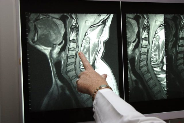 Шейные сосуды и остеохондроз - Все про гипертонию