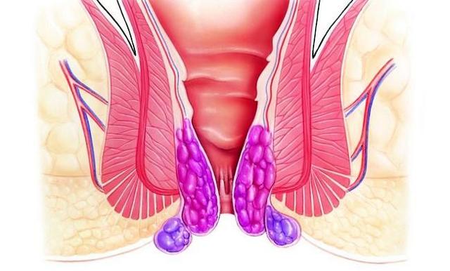 Через сколько проходит геморрой после родов? - Mamapedia