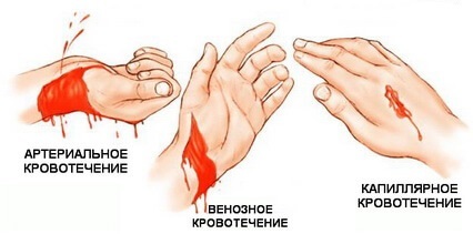 Правила наложения жгута: этапы, особенности, контроль