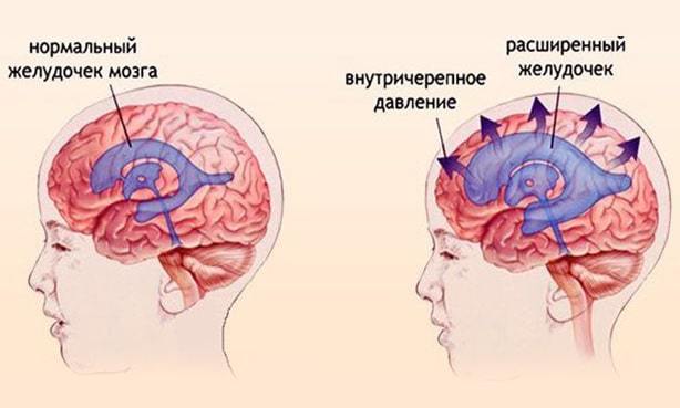 Гипертензионный синдром у детей и взрослых: симптомы, лечение