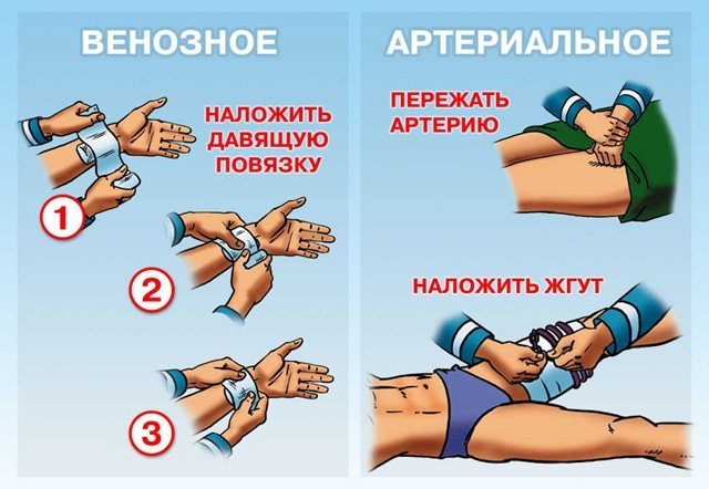 Правила наложения жгута: этапы, особенности, контроль