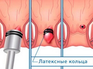 Удаление геморроя – современные операции