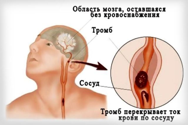 Симптомы Болезней Сосудов Шеи и Головы: Основные Проявления