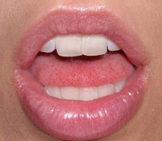 Афтозный стоматит у детей и взрослых: фото, лечение