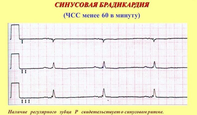 Синусовый ритм: что это в заключении ЭКГ, расшифровка и норма