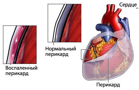 Перикардит: симптомы, лечение