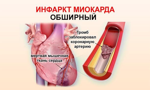 Циркулярный инфаркт миокарда прогноз - Все про гипертонию
