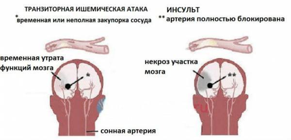От чего бывает инсульт и почему он происходит