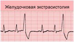 Аритмия какая бывает