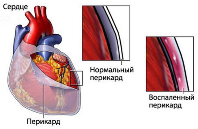 Перикардит: симптомы, лечение