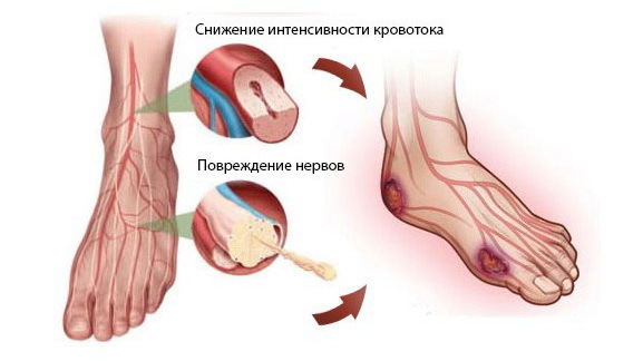 Диабетическая ангиопатия нижних конечностей: лечение сосудов при сахарном диабете, симптомы