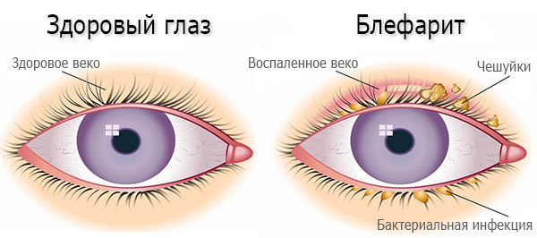 Глазные капли Тобрадекс – инструкция, отзывы, аналоги