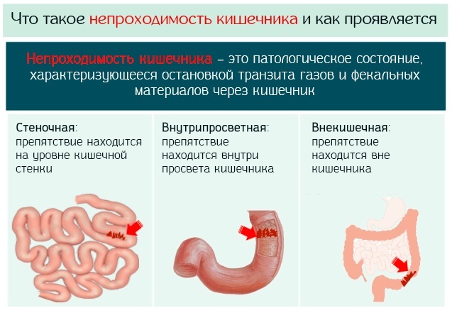 Пупочная грыжа у детей: фото, лечение и симптомы у детей