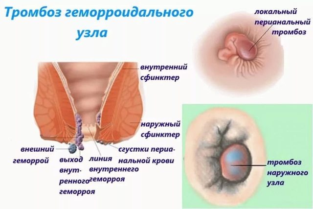 Клизма при геморрое: можно ли делать при заболевании