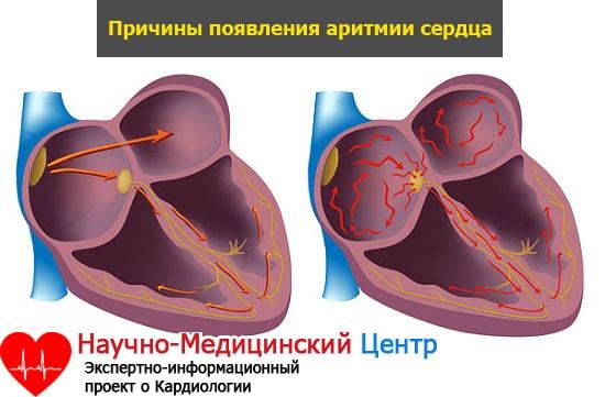 Аритмия сердца: симптомы, лечение