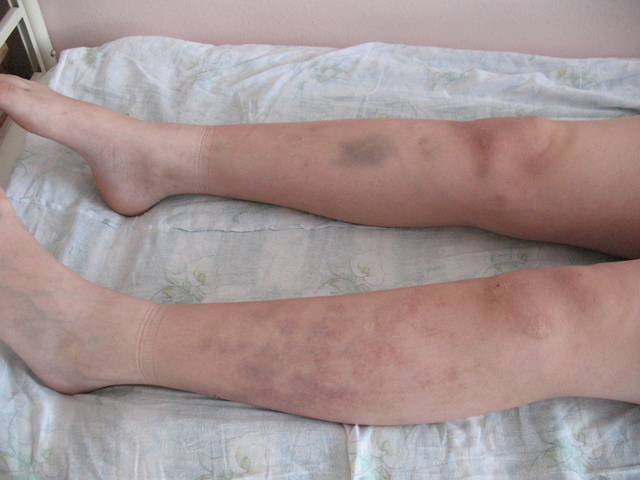 Идиопатическая тромбоцитопеническая пурпура.