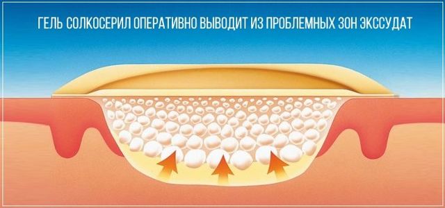 Солкосерил мазь и гель - инструкция по применению, аналоги