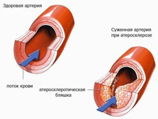 Аорта уплотнена что это значит — Сердце