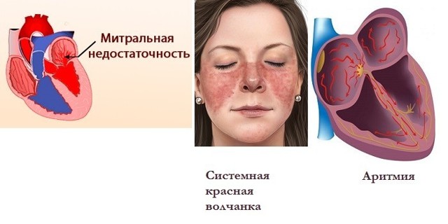 Ноющая боль в области сердца: причины и лечение