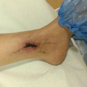 Осложнения и последствия после склеротерапии