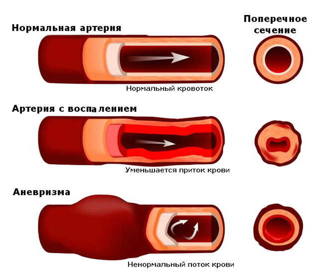 Аневризма сосудов головного мозга: симптомы, лечение