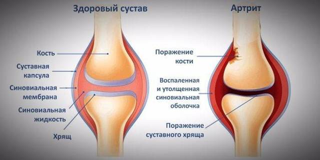 Артрит стопы симптомы и лечение — Суставы