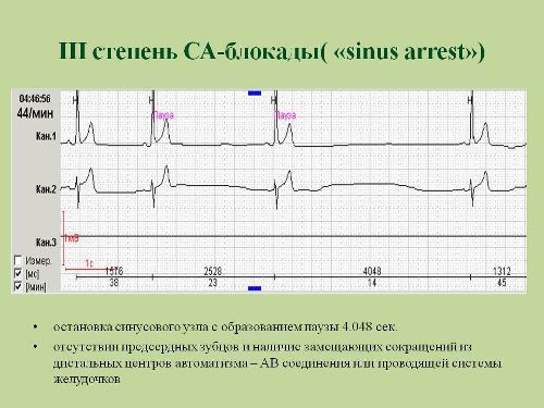 Блокады сердца на экг - Всё о сердце