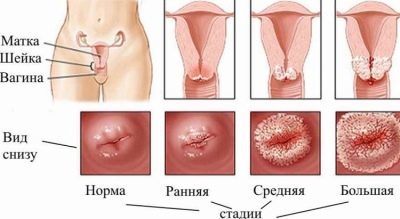 Кровь из влагалища, почему идет кровь из влагалища, после секса, но не месячные, при беременности