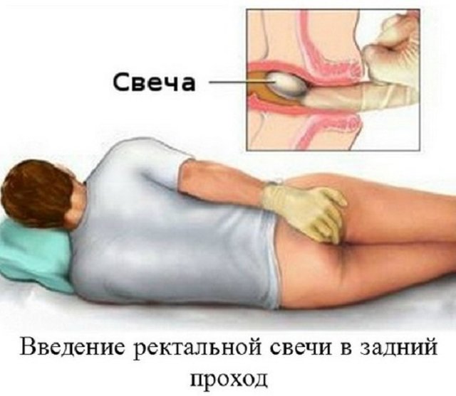 Свечи из картофеля от геморроя: как делать, лечение