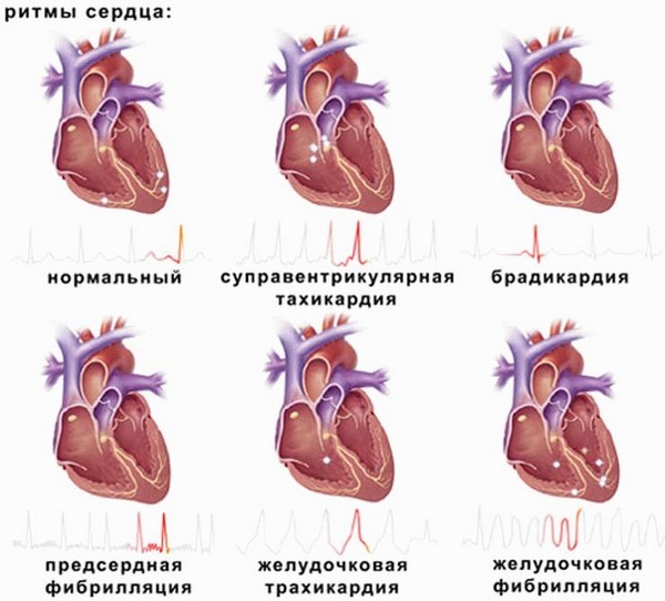 Аритмия у детей: симптомы, лечение, причины