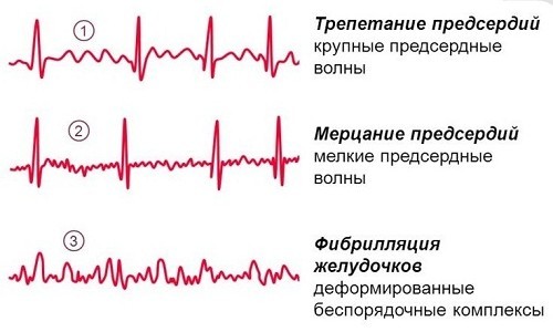 Лечение постоянной формы мерцательной аритмии, фибрилляции и трепетания предсердий.