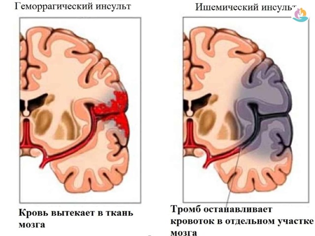 Предпосылки инсульта головного мозга у женщин - как избежать инсульта у женщин