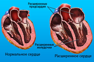 Порок митрального клапана сердца