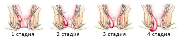 Первая стадия геморроя: лечение, причины, симптомы