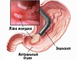 О Чем Говорит Боль в Грудной Клетке Посередине
