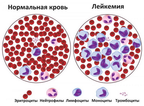 Пересадка костного мозга при лейкозе, можно ли вылечиться, прогноз