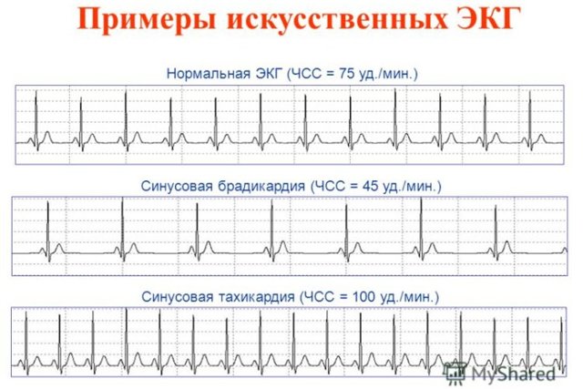 Позиция сердца вертикальная: как выглядит, признаки заболевания, расшифровка, что это