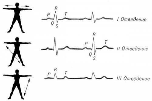 Стандартные отведения от конечностей - 1,2,3