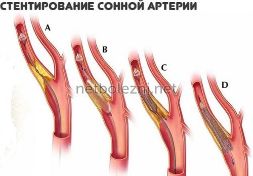 Стентирование коронарных артерий: операция, послеоперационный период, реабилитация
