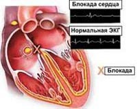 Атриовентрикулярная блокада (ав-блокада)