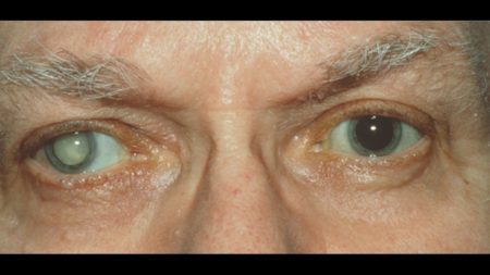 При сахарном диабете упало зрение что делать — Диабет и всё о нём