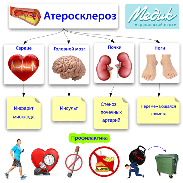 Какой врач лечит сосуды головного мозга, атеросклероз?