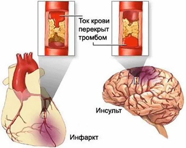 Высокое нижнее давление – причины и интересные факты