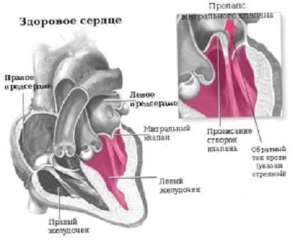 Регургитация митрального клапана 1 и 2 степени