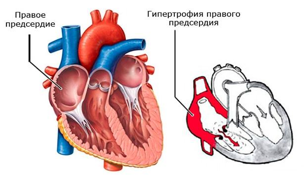 Гипертрофия правого предсердия на ЭКГ: симптомы перегрузки сердца