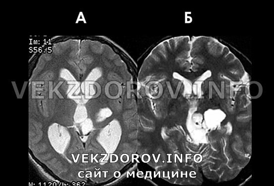 Асимметрия боковых желудочков мозга у детей и взрослых