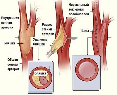 Нестенозирующий атеросклероз внечерепных отделов брахиоцефальных артерий - Всё о сердце