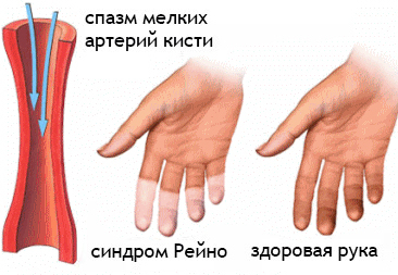 Болезнь Рейно – симптомы у женщин. Болезнь и синдром Рейно – причины, диагностика, лечение, прогноз